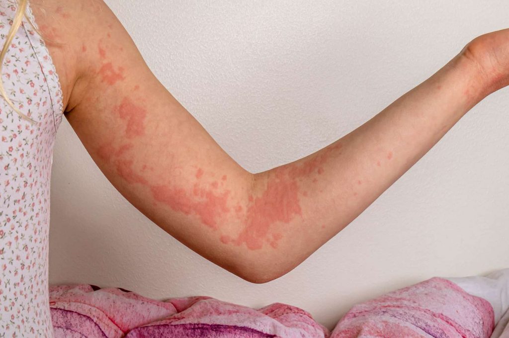 Allergic reactions(dermatitis, arthritis, Psoriasis)
